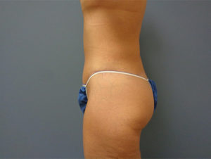 Tummy Tuck Before & After Pictures Nashville, TN