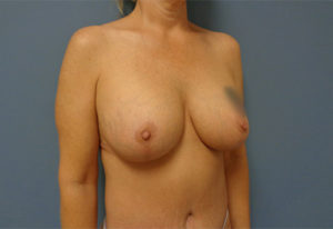 Breast Augmentation with Lift Before & After Pictures Nashville, TN