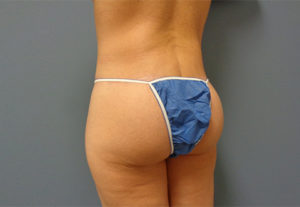 Butt Augmentation Before And After Pictures Nashville, TN