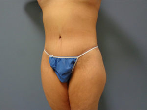 Tummy Tuck Before & After Pictures Nashville, TN