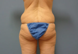 Butt Augmentation Before And After Pictures Nashville, TN