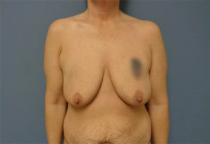 Breast Augmentation with Lift Before & After Pictures Nashville, TN