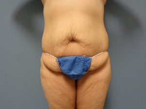 Tummy Tuck Before & After Pictures Nashville, TN