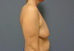 Breast Augmentation with Lift Before & After Pictures Nashville, TN