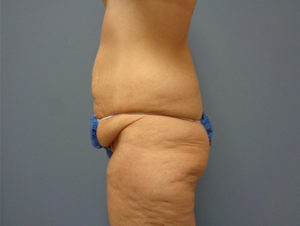 Tummy Tuck Before & After Pictures Nashville, TN