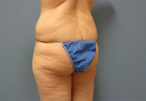 Butt Augmentation Before And After Pictures Nashville, TN