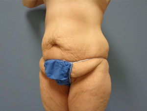 Tummy Tuck Before & After Pictures Nashville, TN