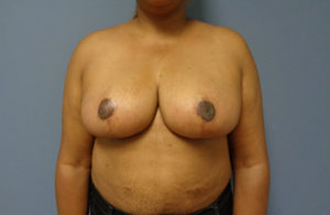 Breast Reduction Before & After Pictures Nashville, TN