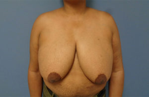 Breast Reduction Before & After Pictures Nashville, TN