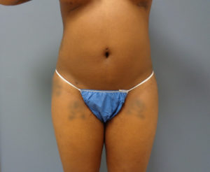Liposuction Before & After Pictures Nashville, TN