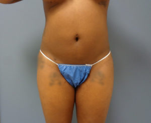 Liposuction Before & After Pictures Nashville, TN