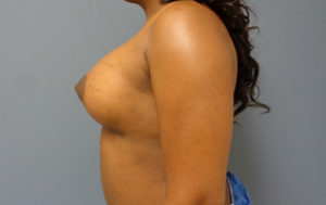 Breast Augmentation Before & After Pictures Nashville, TN