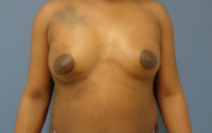 Breast Augmentation Before & After Pictures Nashville, TN