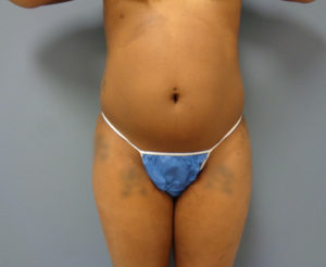 Liposuction Before & After Pictures Nashville, TN