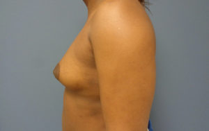 Breast Augmentation Before & After Pictures Nashville, TN