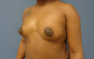 Breast Augmentation Before & After Pictures Nashville, TN