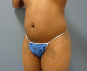 Liposuction Before & After Pictures Nashville, TN