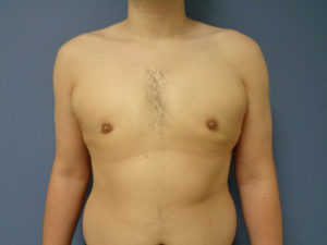 Gynecomastia Before & After Pictures Nashville, TN