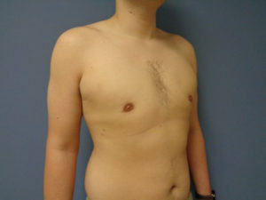 Gynecomastia Before & After Pictures Nashville, TN