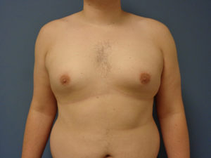 Gynecomastia Before & After Pictures Nashville, TN