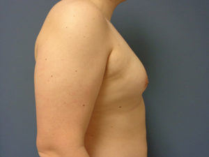 Gynecomastia Before & After Pictures Nashville, TN