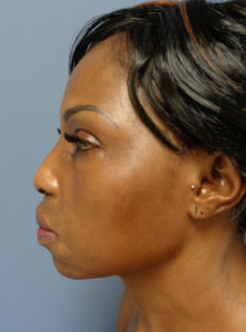 Rhinoplasty Before & After Pictures Nashville, TN