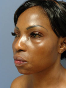 Rhinoplasty Before & After Pictures Nashville, TN