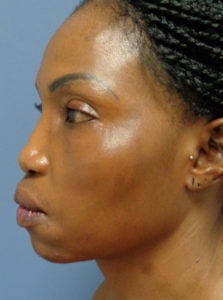 Rhinoplasty Before & After Pictures Nashville, TN