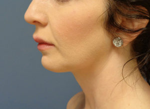 Chin Augmentation Before & After Pictures Nashville, TN