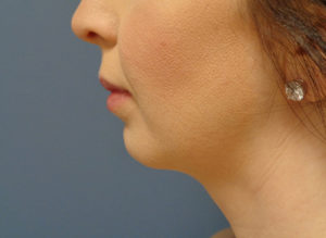 Chin Augmentation Before & After Pictures Nashville, TN