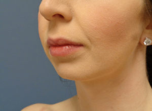 Chin Augmentation Before & After Pictures Nashville, TN