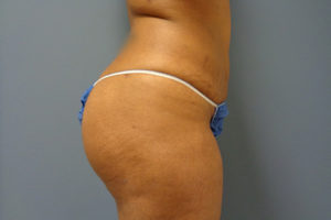 Butt Augmentation Before And After Pictures Nashville, TN
