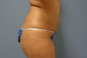Butt Augmentation Before And After Pictures Nashville, TN