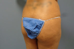 Butt Augmentation Before And After Pictures Nashville, TN