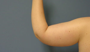 Arm Lift Before & After Pictures Nashville, TN