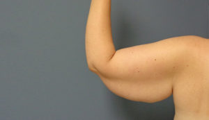 Arm Lift Before & After Pictures Nashville, TN