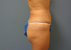 Tummy Tuck Before & After Pictures in Nashville, TN