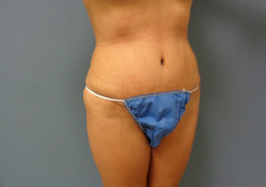 Tummy Tuck Before & After Pictures in Nashville, TN