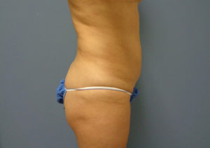 Tummy Tuck Before & After Pictures in Nashville, TN