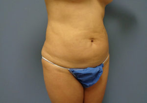 Tummy Tuck Before & After Pictures in Nashville, TN