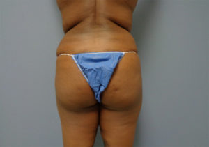 Butt Augmentation Before & After Pictures in Nashville, TN