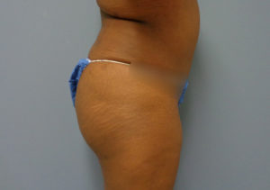 Butt Augmentation Before & After Pictures in Nashville, TN