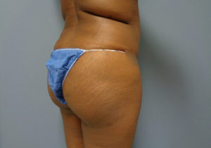 Butt Augmentation Before & After Pictures in Nashville, TN