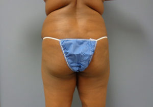 Butt Augmentation Before & After Pictures in Nashville, TN