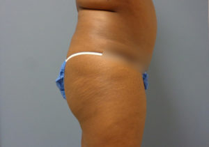 Butt Augmentation Before & After Pictures in Nashville, TN