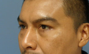 Blepharoplasty Before & After Pictures in Nashville, TN