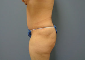 Tummy Tuck Before & After Pictures in Nashville, TN