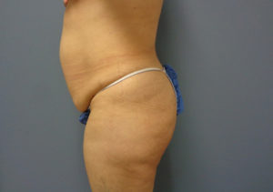 Tummy Tuck Before & After Pictures in Nashville, TN