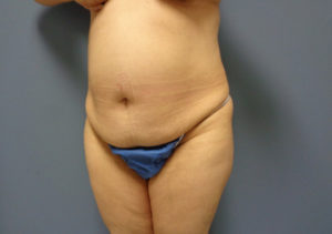 Tummy Tuck Before & After Pictures in Nashville, TN