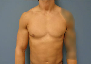 Gynecomastia Before & After Pictures in Nashville, TN